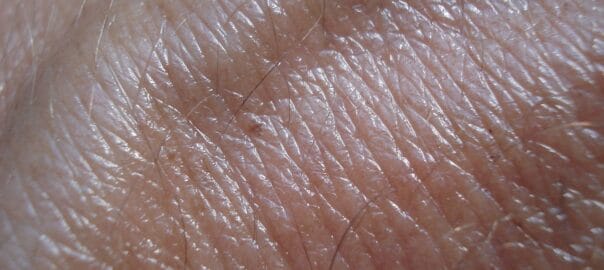 The Biomechanics of Dermal Fillers